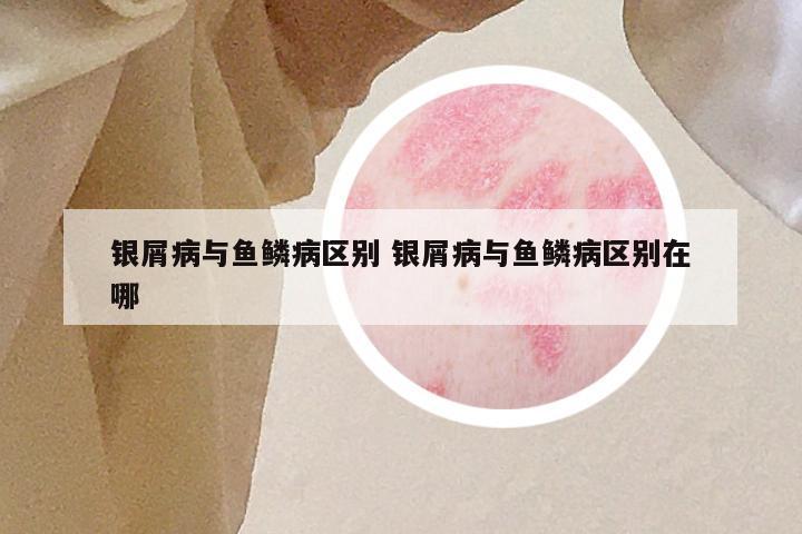 银屑病与鱼鳞病区别 银屑病与鱼鳞病区别在哪