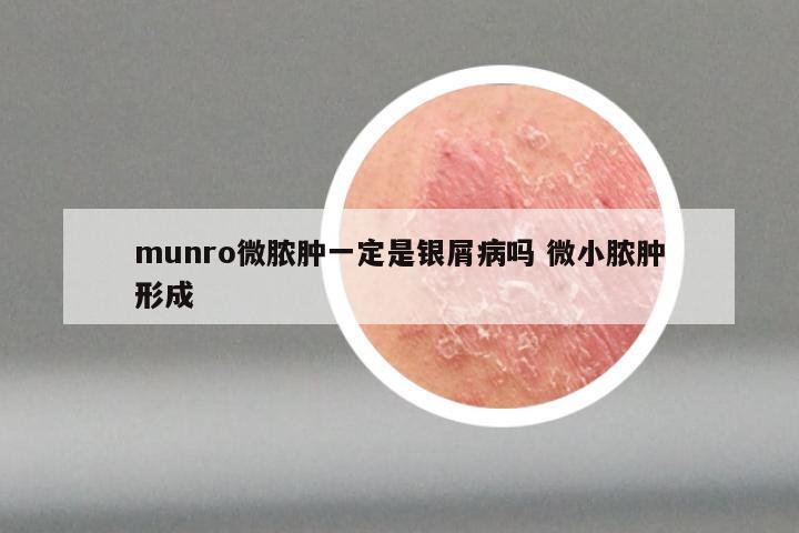 munro微脓肿一定是银屑病吗 微小脓肿形成