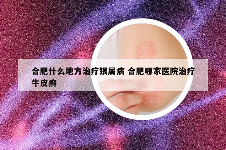 合肥什么地方治疗银屑病 合肥哪家医院治疗牛皮癣