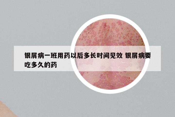 银屑病一班用药以后多长时间见效 银屑病要吃多久的药