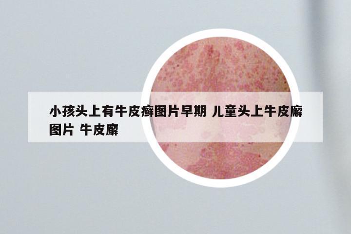 小孩头上有牛皮癣图片早期 儿童头上牛皮廨图片 牛皮廨