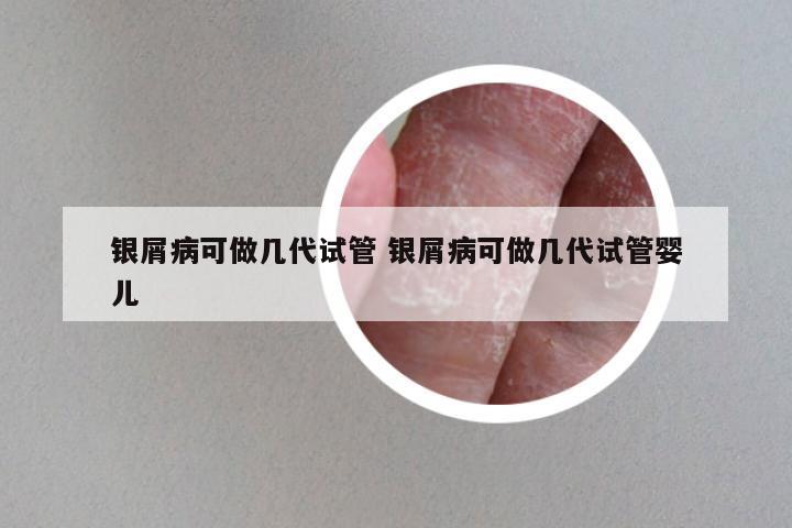 银屑病可做几代试管 银屑病可做几代试管婴儿