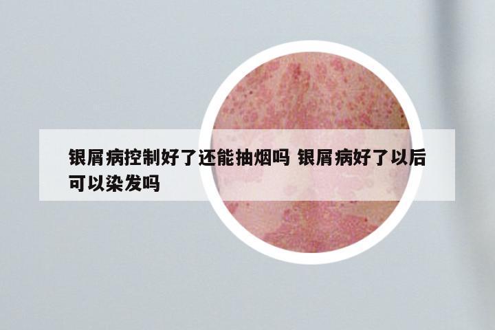 银屑病控制好了还能抽烟吗 银屑病好了以后可以染发吗