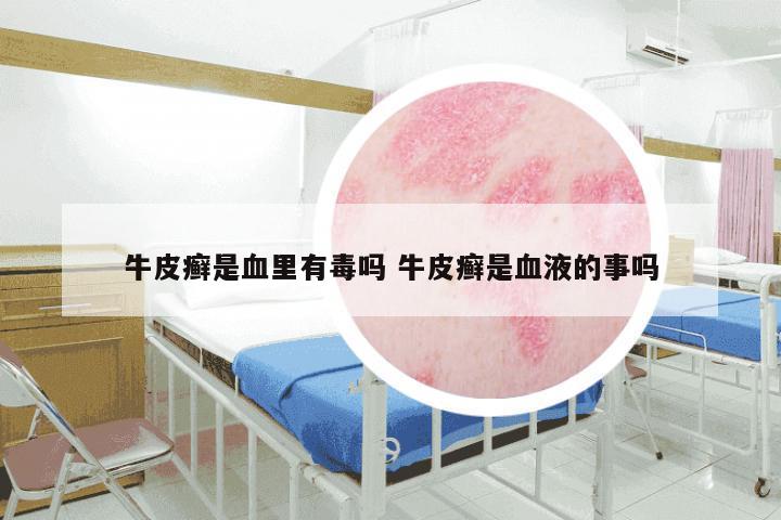 牛皮癣是血里有毒吗 牛皮癣是血液的事吗