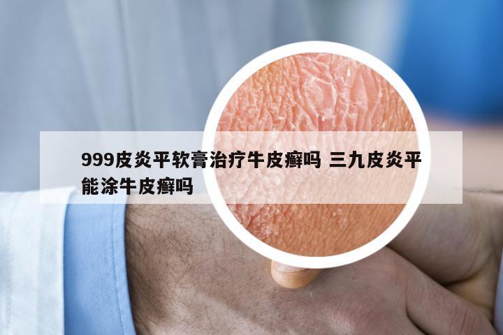 999皮炎平软膏治疗牛皮癣吗 三九皮炎平能涂牛皮癣吗