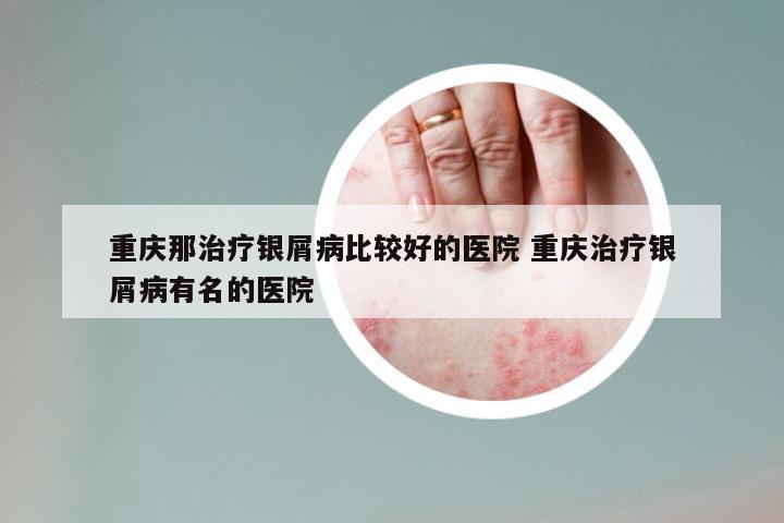重庆那治疗银屑病比较好的医院 重庆治疗银屑病有名的医院