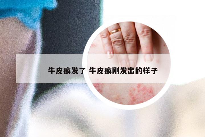 牛皮癣发了 牛皮癣刚发出的样子