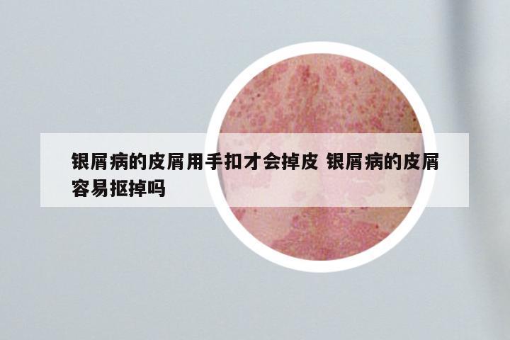 银屑病的皮屑用手扣才会掉皮 银屑病的皮屑容易抠掉吗