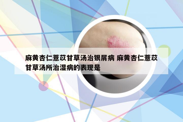 麻黄杏仁薏苡甘草汤治银屑病 麻黄杏仁薏苡甘草汤所治湿病的表现是