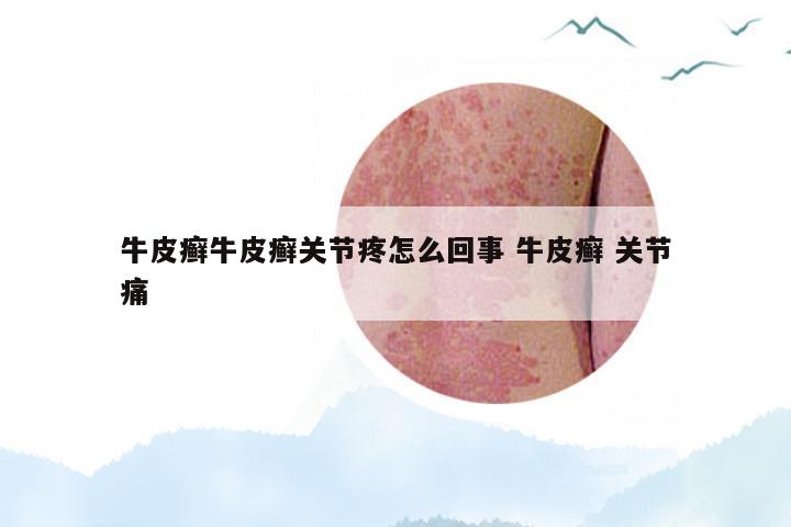 牛皮癣牛皮癣关节疼怎么回事 牛皮癣 关节痛