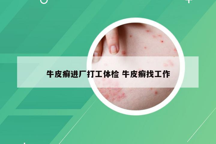 牛皮癣进厂打工体检 牛皮癣找工作