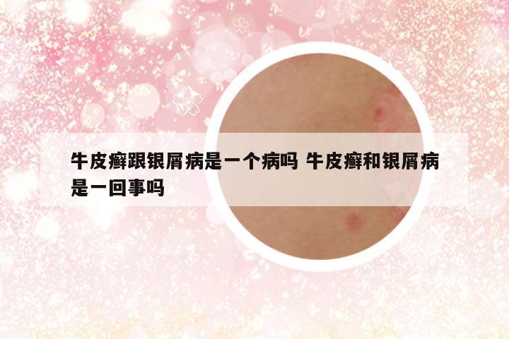 牛皮癣跟银屑病是一个病吗 牛皮癣和银屑病是一回事吗