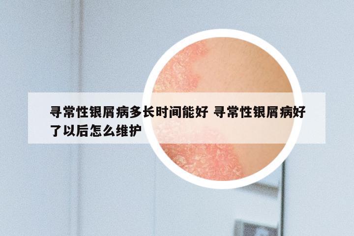 寻常性银屑病多长时间能好 寻常性银屑病好了以后怎么维护