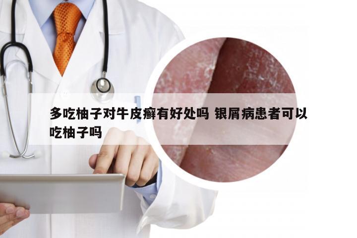 多吃柚子对牛皮癣有好处吗 银屑病患者可以吃柚子吗