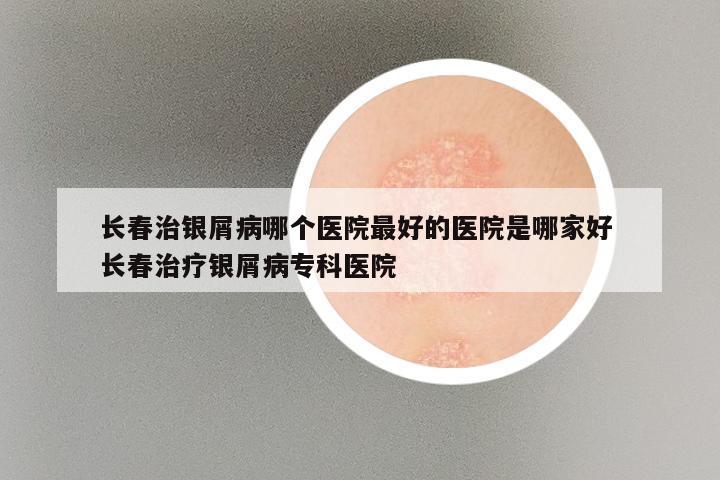 长春治银屑病哪个医院最好的医院是哪家好 长春治疗银屑病专科医院