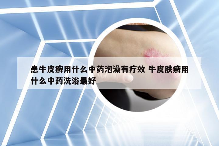 患牛皮癣用什么中药泡澡有疗效 牛皮肤癣用什么中药洗浴最好