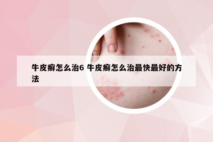 牛皮癣怎么治6 牛皮癣怎么治最快最好的方法