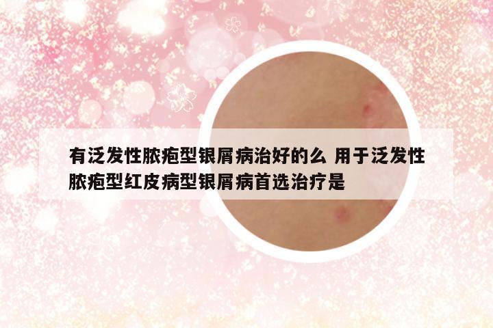 有泛发性脓疱型银屑病治好的么 用于泛发性脓疱型红皮病型银屑病首选治疗是