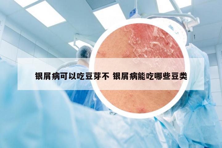 银屑病可以吃豆芽不 银屑病能吃哪些豆类