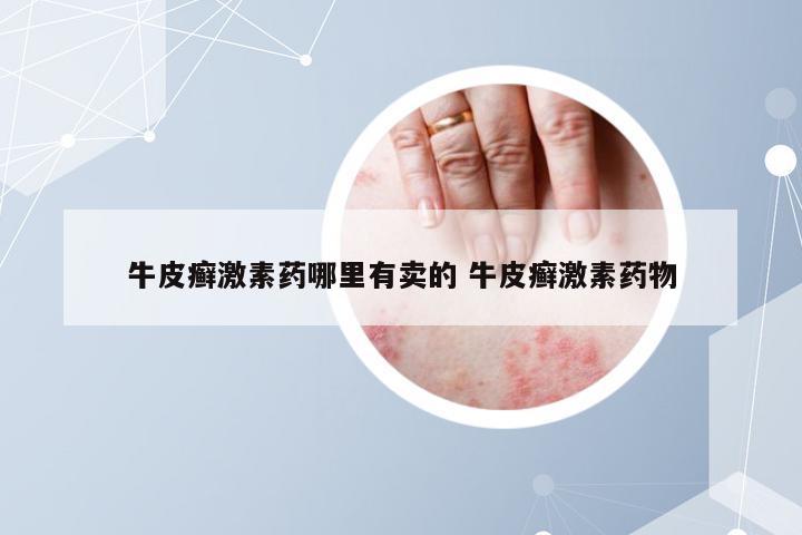 牛皮癣激素药哪里有卖的 牛皮癣激素药物
