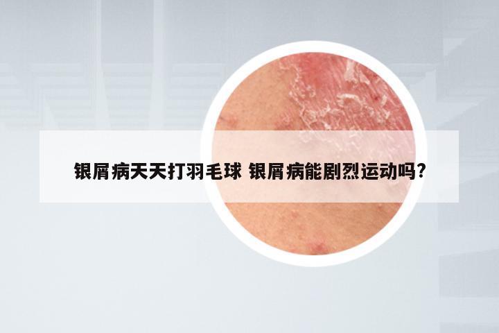 银屑病天天打羽毛球 银屑病能剧烈运动吗?