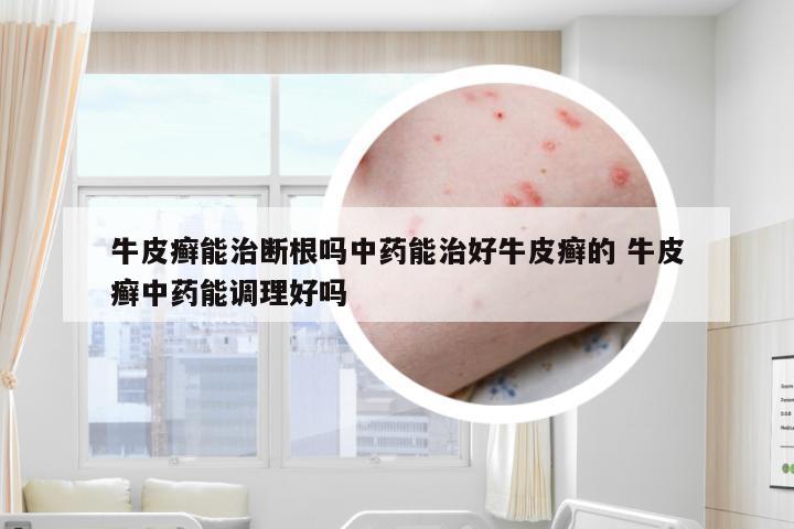 牛皮癣能治断根吗中药能治好牛皮癣的 牛皮癣中药能调理好吗
