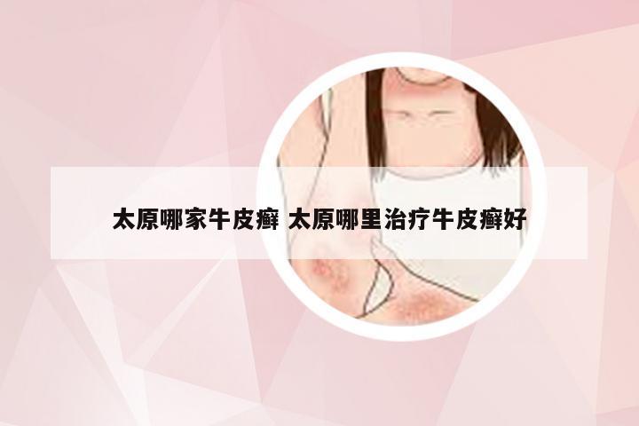 太原哪家牛皮癣 太原哪里治疗牛皮癣好