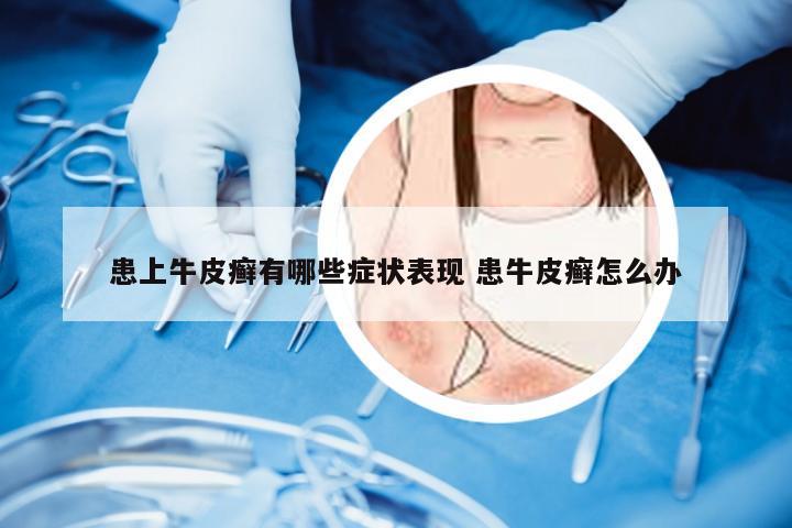 患上牛皮癣有哪些症状表现 患牛皮癣怎么办