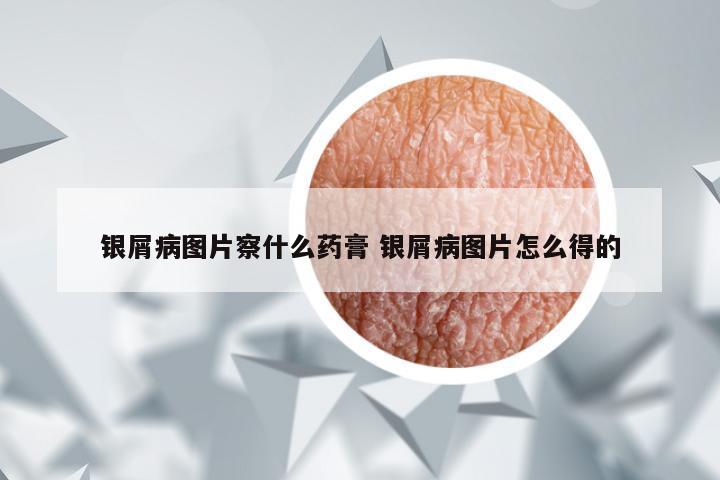银屑病图片察什么药膏 银屑病图片怎么得的