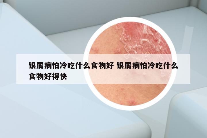 银屑病怕冷吃什么食物好 银屑病怕冷吃什么食物好得快