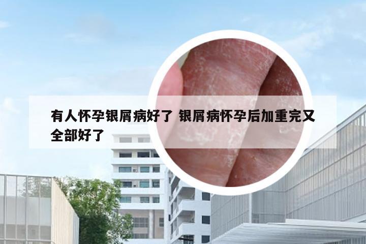 有人怀孕银屑病好了 银屑病怀孕后加重完又全部好了
