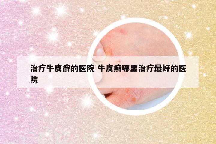 治疗牛皮癣的医院 牛皮癣哪里治疗最好的医院