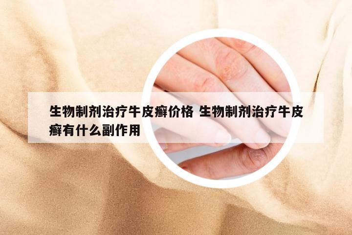 生物制剂治疗牛皮癣价格 生物制剂治疗牛皮癣有什么副作用