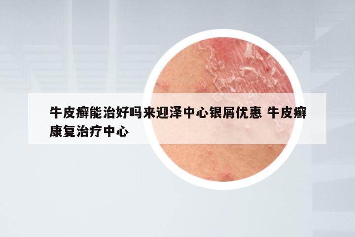 牛皮癣能治好吗来迎泽中心银屑优惠 牛皮癣康复治疗中心