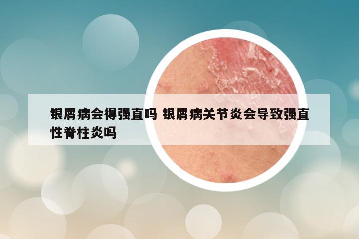 银屑病会得强直吗 银屑病关节炎会导致强直性脊柱炎吗