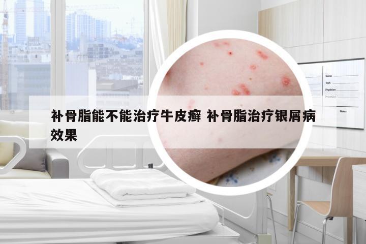 补骨脂能不能治疗牛皮癣 补骨脂治疗银屑病效果