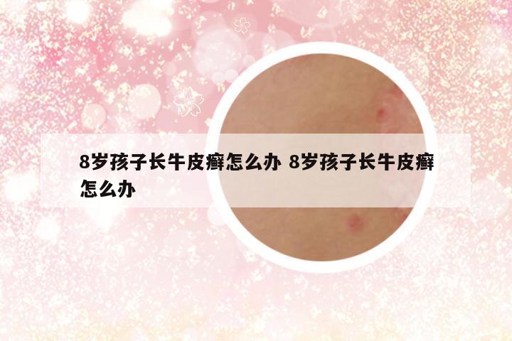 8岁孩子长牛皮癣怎么办 8岁孩子长牛皮癣怎么办