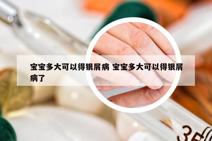 宝宝多大可以得银屑病 宝宝多大可以得银屑病了