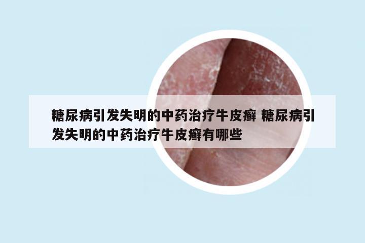 糖尿病引发失明的中药治疗牛皮癣 糖尿病引发失明的中药治疗牛皮癣有哪些
