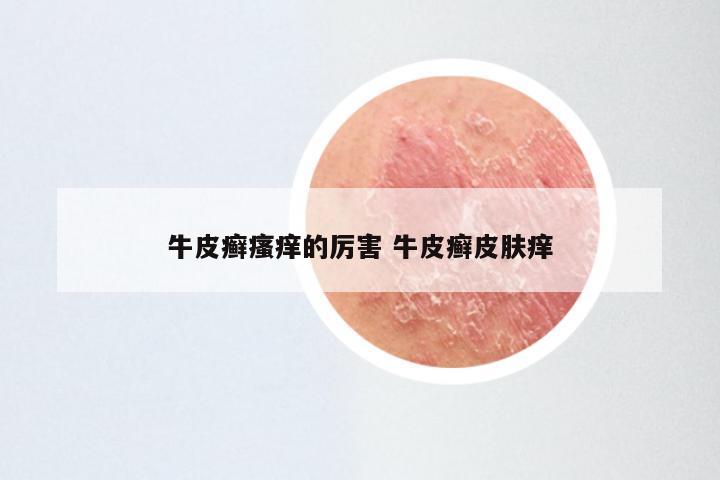 牛皮癣瘙痒的厉害 牛皮癣皮肤痒