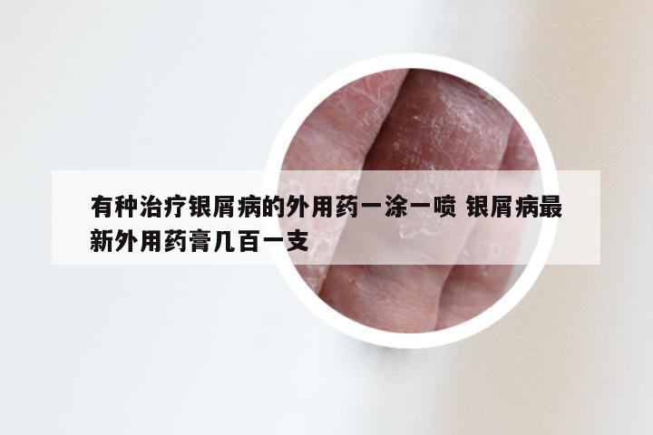 有种治疗银屑病的外用药一涂一喷 银屑病最新外用药膏几百一支
