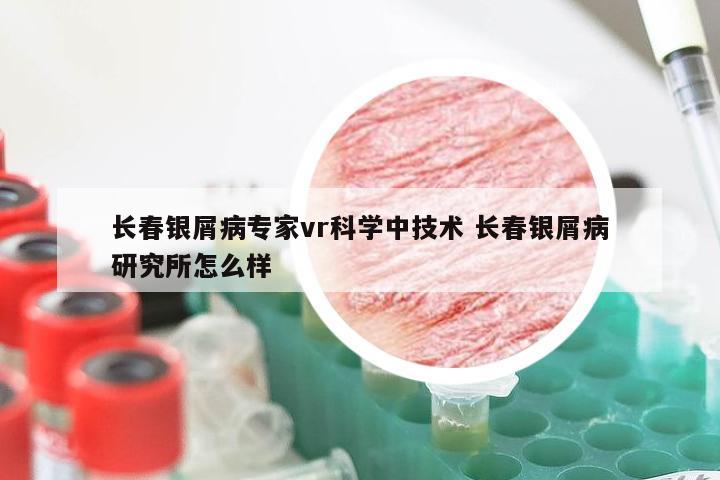 长春银屑病专家vr科学中技术 长春银屑病研究所怎么样