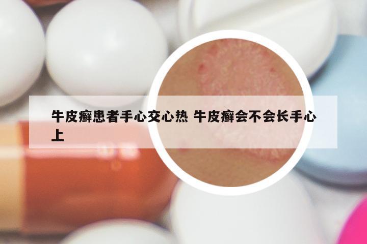 牛皮癣患者手心交心热 牛皮癣会不会长手心上