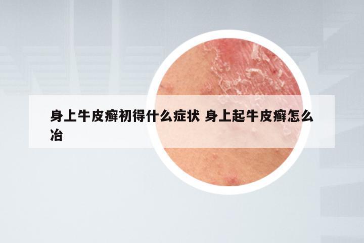 身上牛皮癣初得什么症状 身上起牛皮癣怎么冶