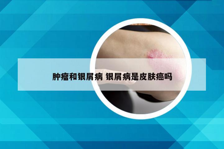 肿瘤和银屑病 银屑病是皮肤癌吗