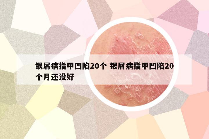 银屑病指甲凹陷20个 银屑病指甲凹陷20个月还没好