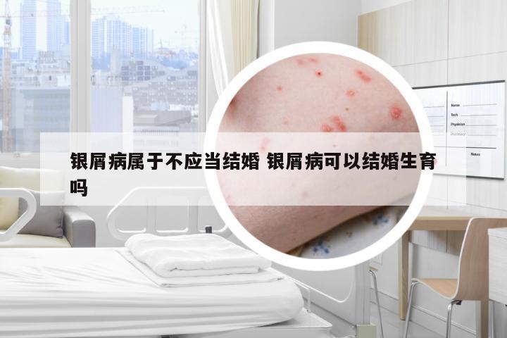 银屑病属于不应当结婚 银屑病可以结婚生育吗