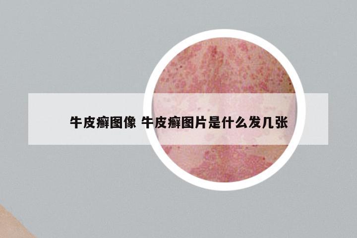 牛皮癣图像 牛皮癣图片是什么发几张