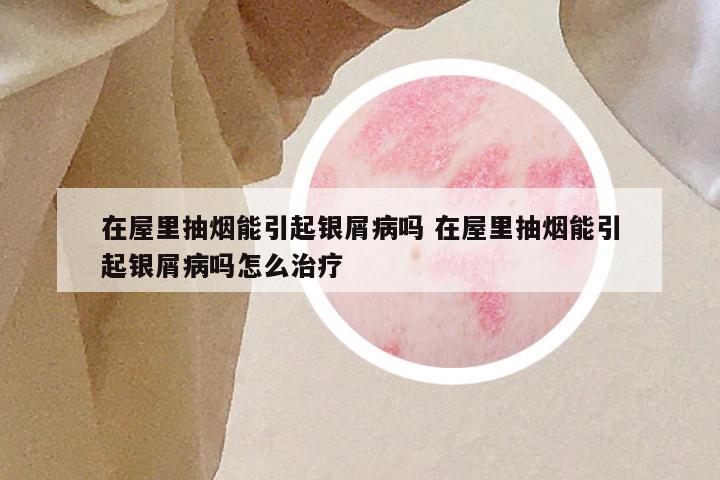 在屋里抽烟能引起银屑病吗 在屋里抽烟能引起银屑病吗怎么治疗