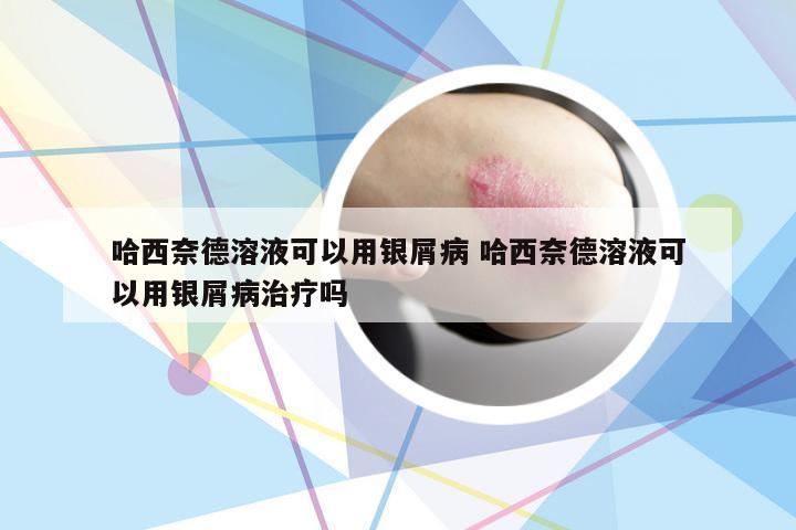 哈西奈德溶液可以用银屑病 哈西奈德溶液可以用银屑病治疗吗